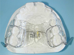 solucion de ortodoncia pul 2