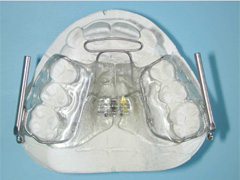 solucion de ortodoncia pul 4